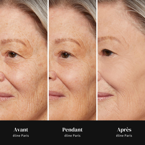 éline™ - Lisseur de Rides